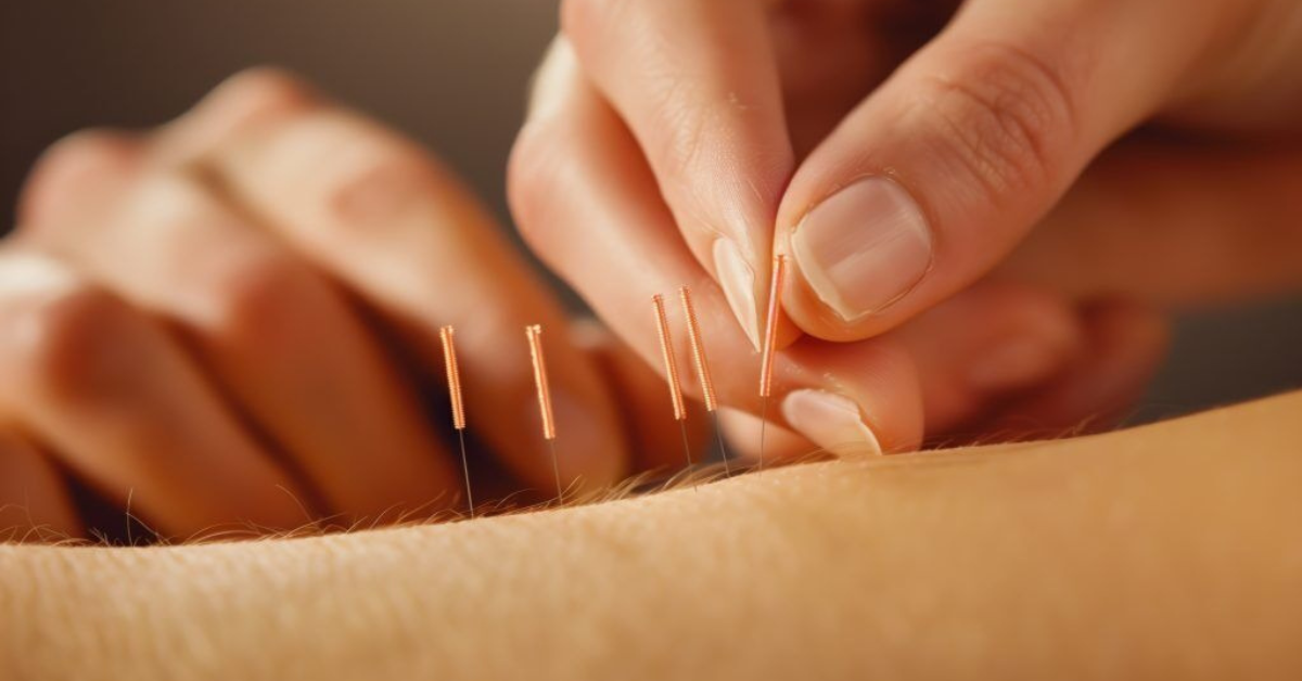 Best TCM Acupuncture